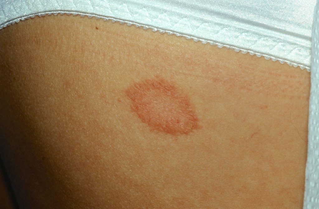 Pityriasis Rosea - Causes, Rash, Herald Patch, Stages, Treatment