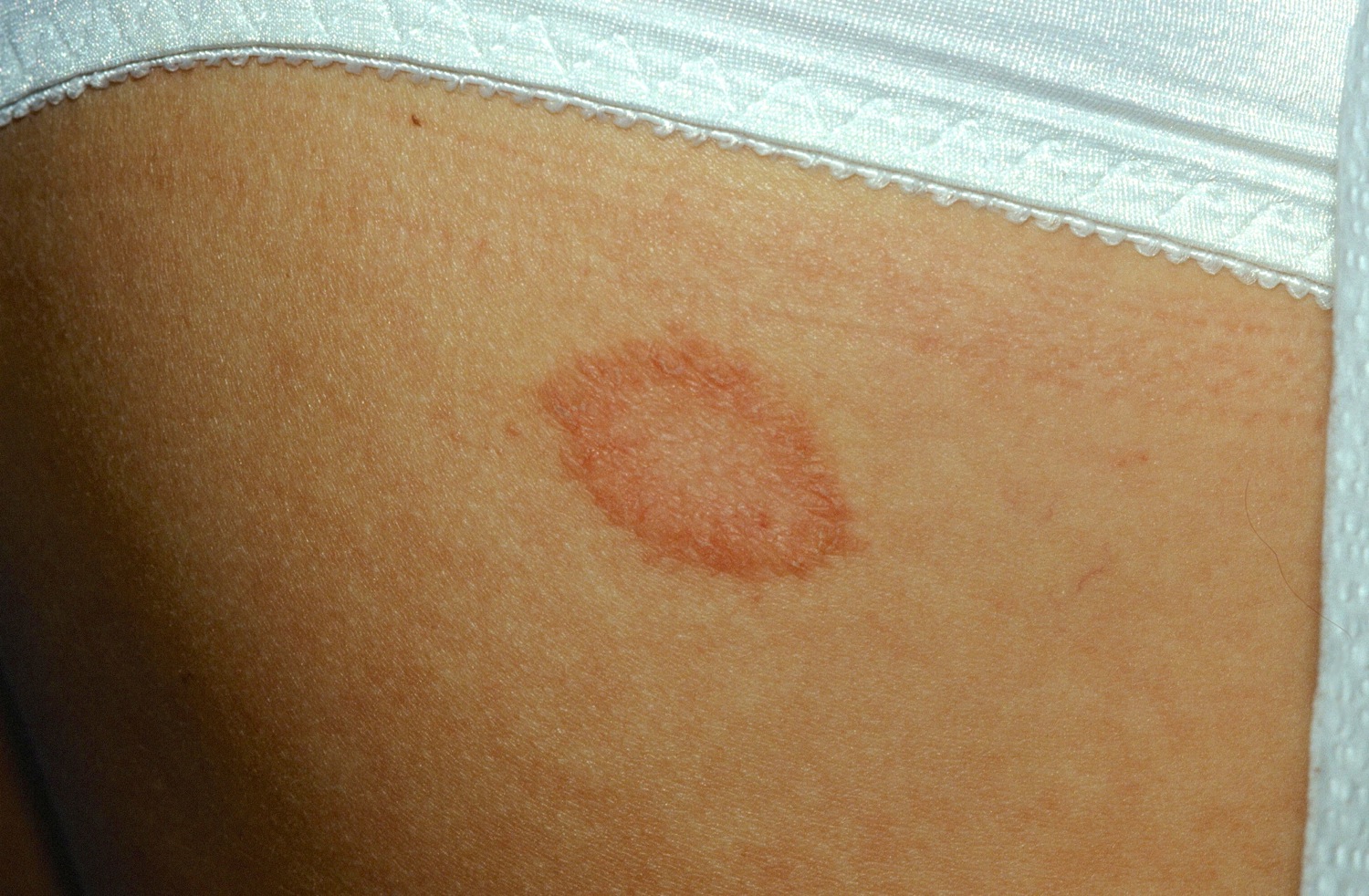 pityriasis-rosea-causes-rash-herald-patch-stages-sexiz-pix