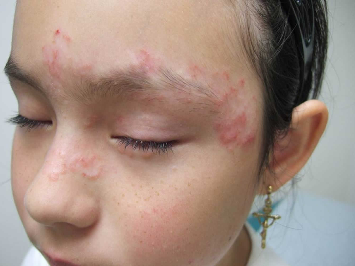 pityriasis-rosea-causes-rash-herald-patch-stages-treatment