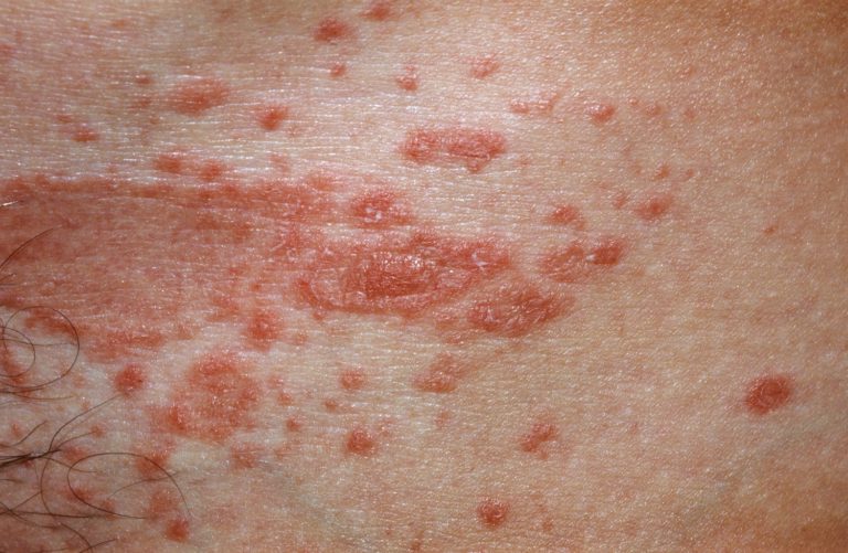 Pityriasis Rosea - Causes, Rash, Herald Patch, Stages, Treatment