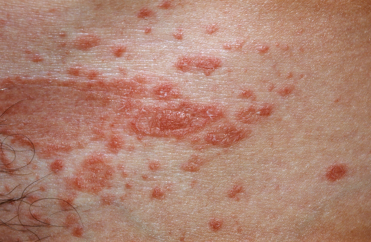 Pityriasis Rosea Causes Rash Herald Patch Stages Treatment