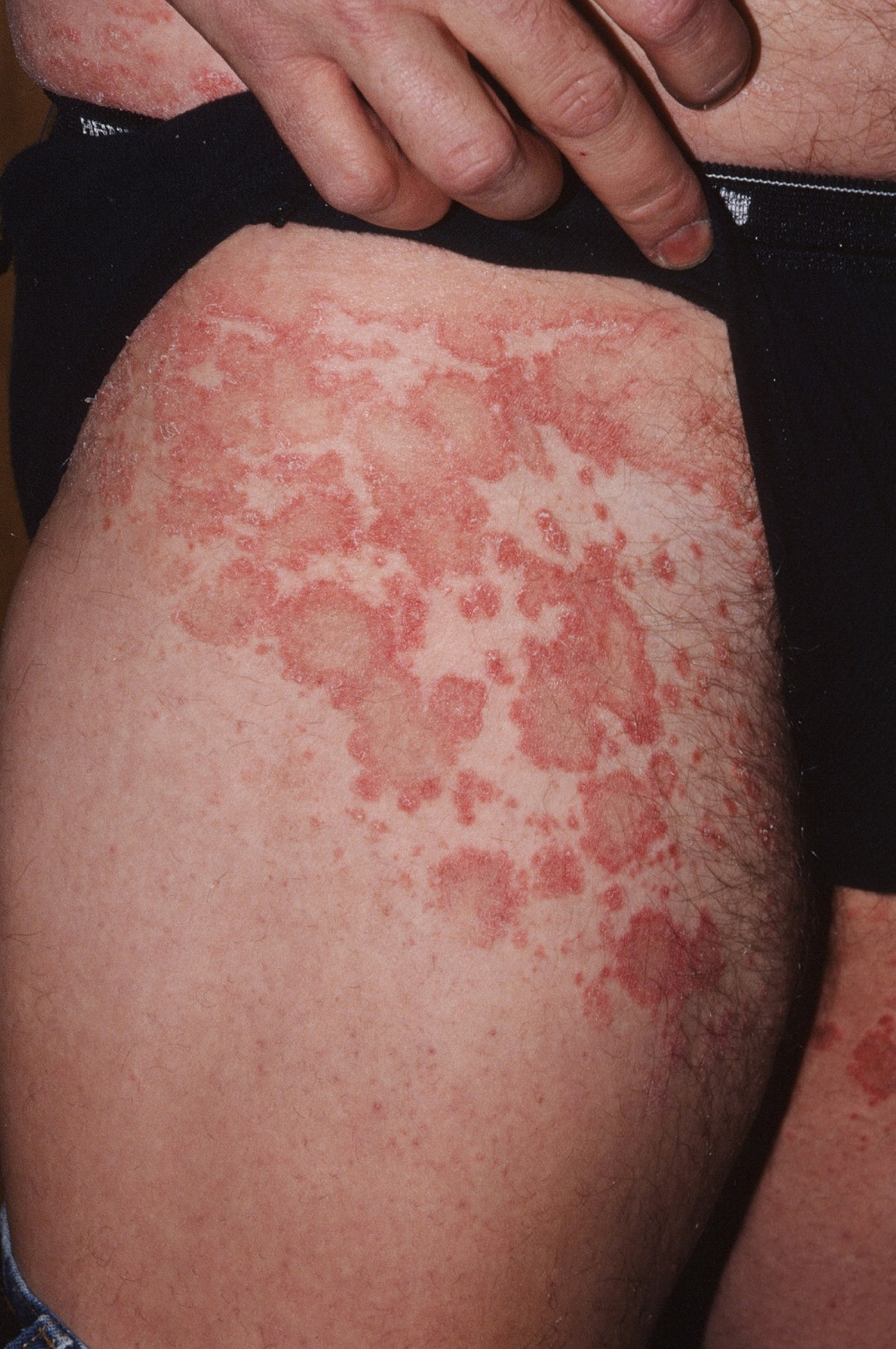 Pityriasis Rosea Causes, Rash, Herald Patch, Stages, Treatment