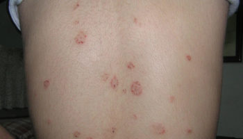 pityriasis rosea rash