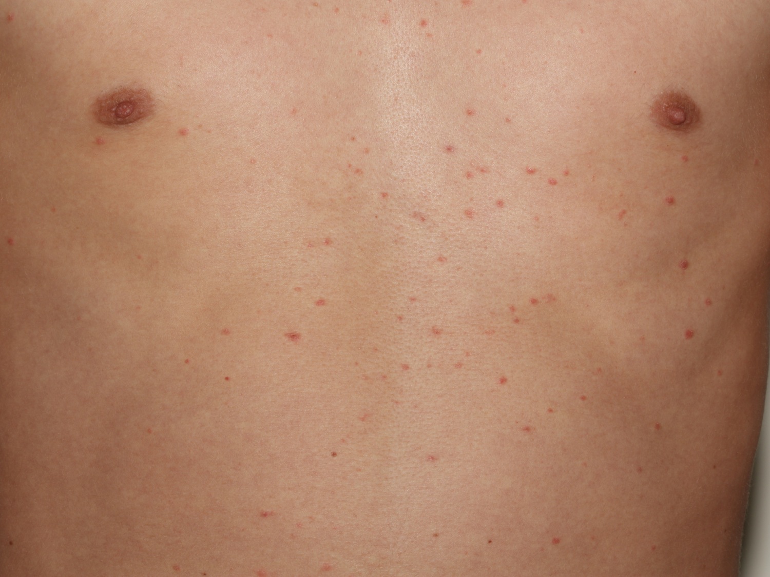 Pityriasis Rosea Causes Rash Herald Patch Stages Treatment