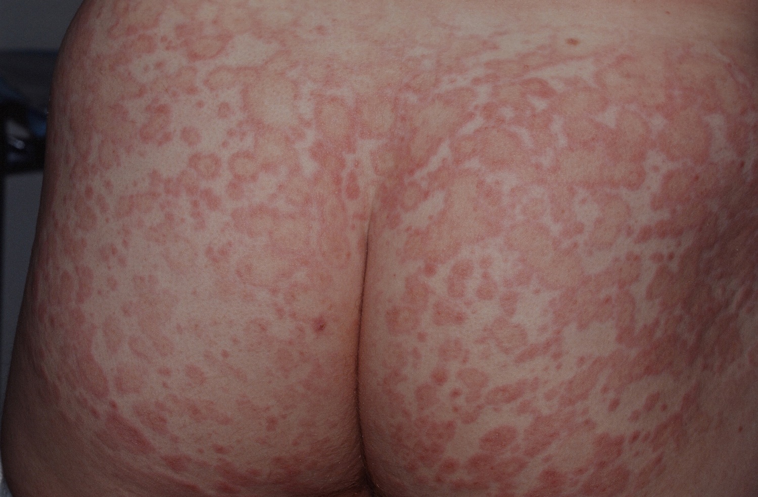 pityriasis rosea christmas tree pattern