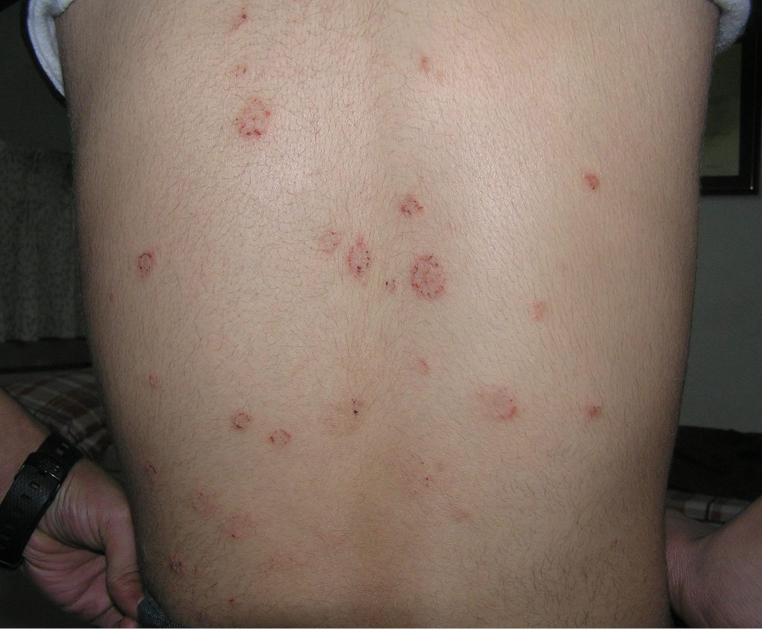 Pityriasis Rosea Causes Rash Herald Patch Stages Treatment