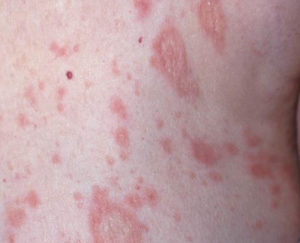 Pityriasis Rosea - Causes, Rash, Herald Patch, Stages, Treatment