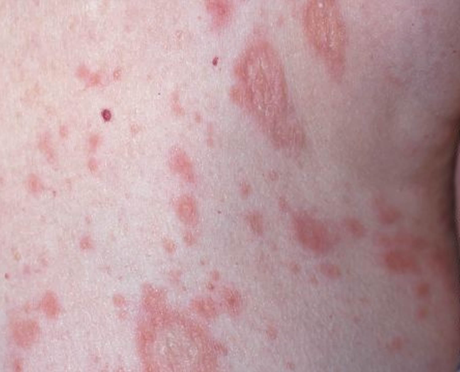 skin rashes that itch and are contagious