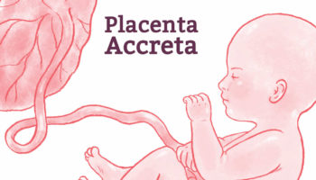 placenta accreta