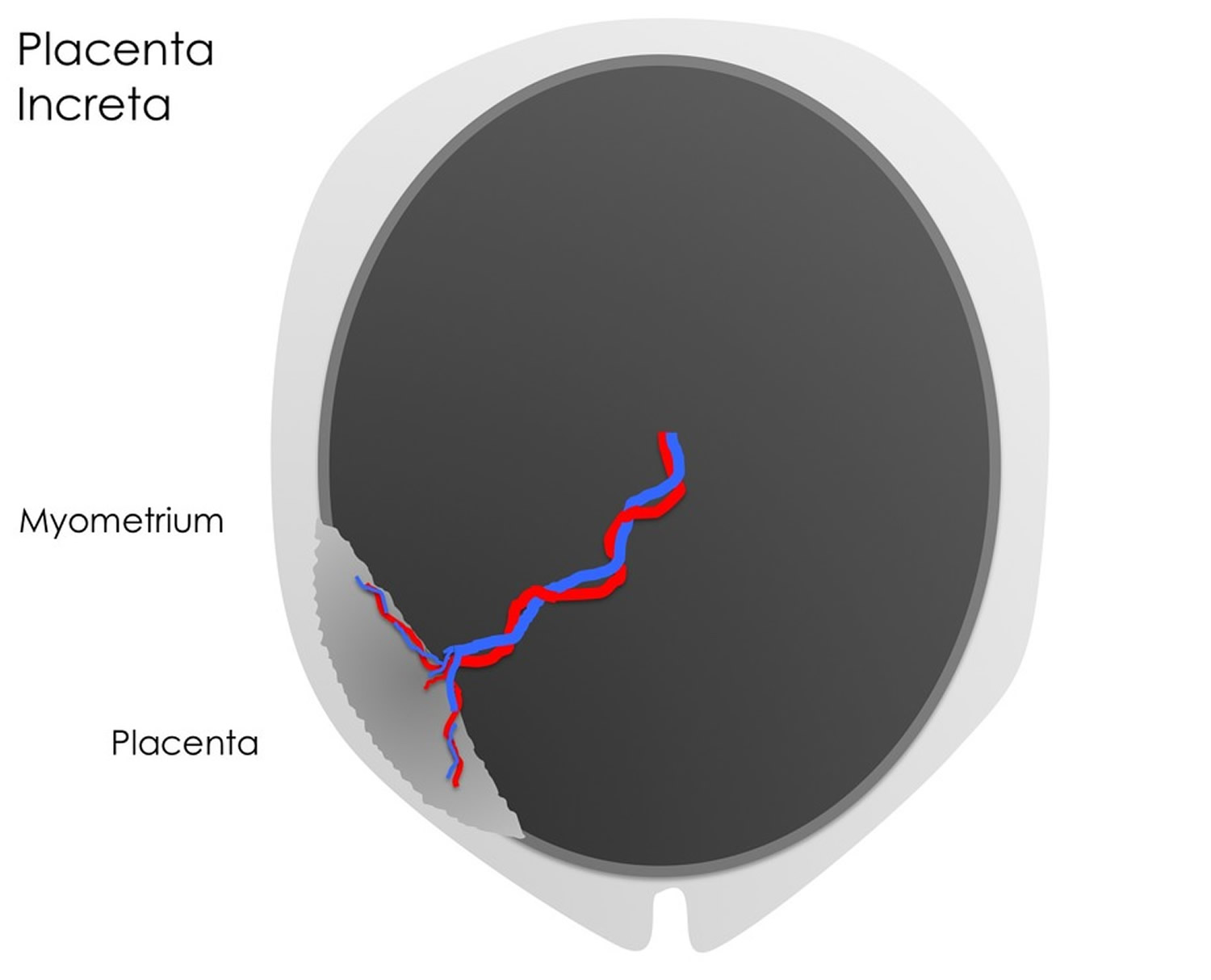 Placenta increta