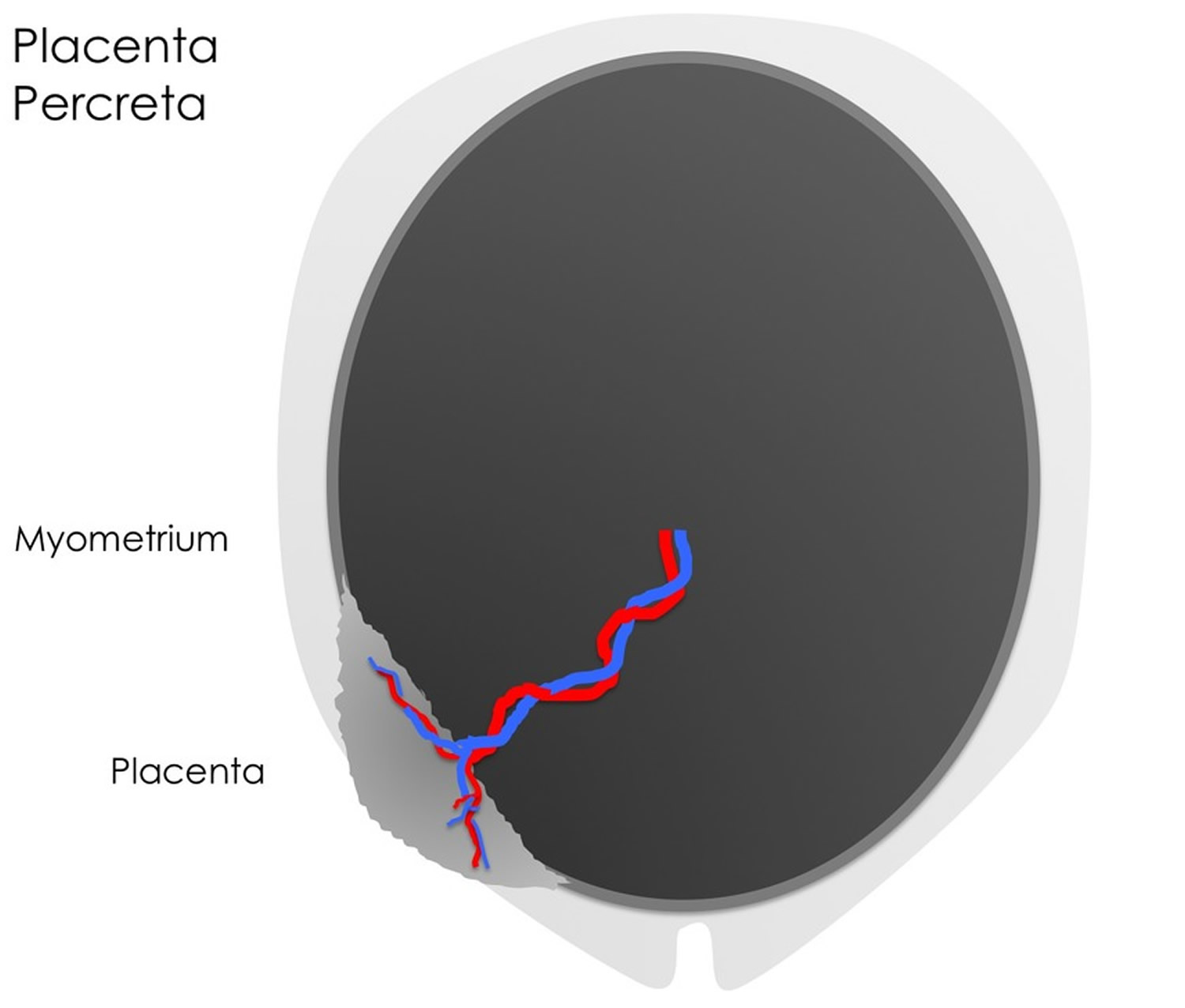 Placenta percreta