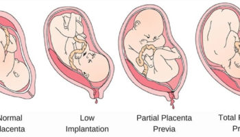 placenta previa
