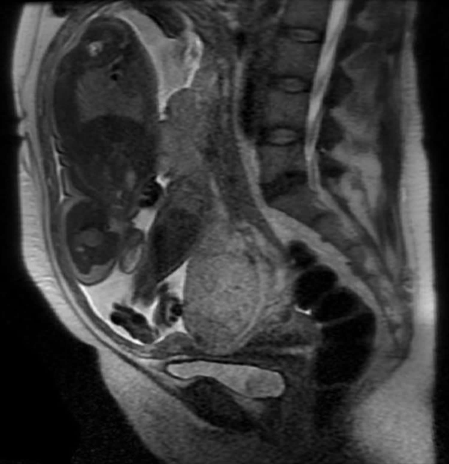 placenta previa - MRI image