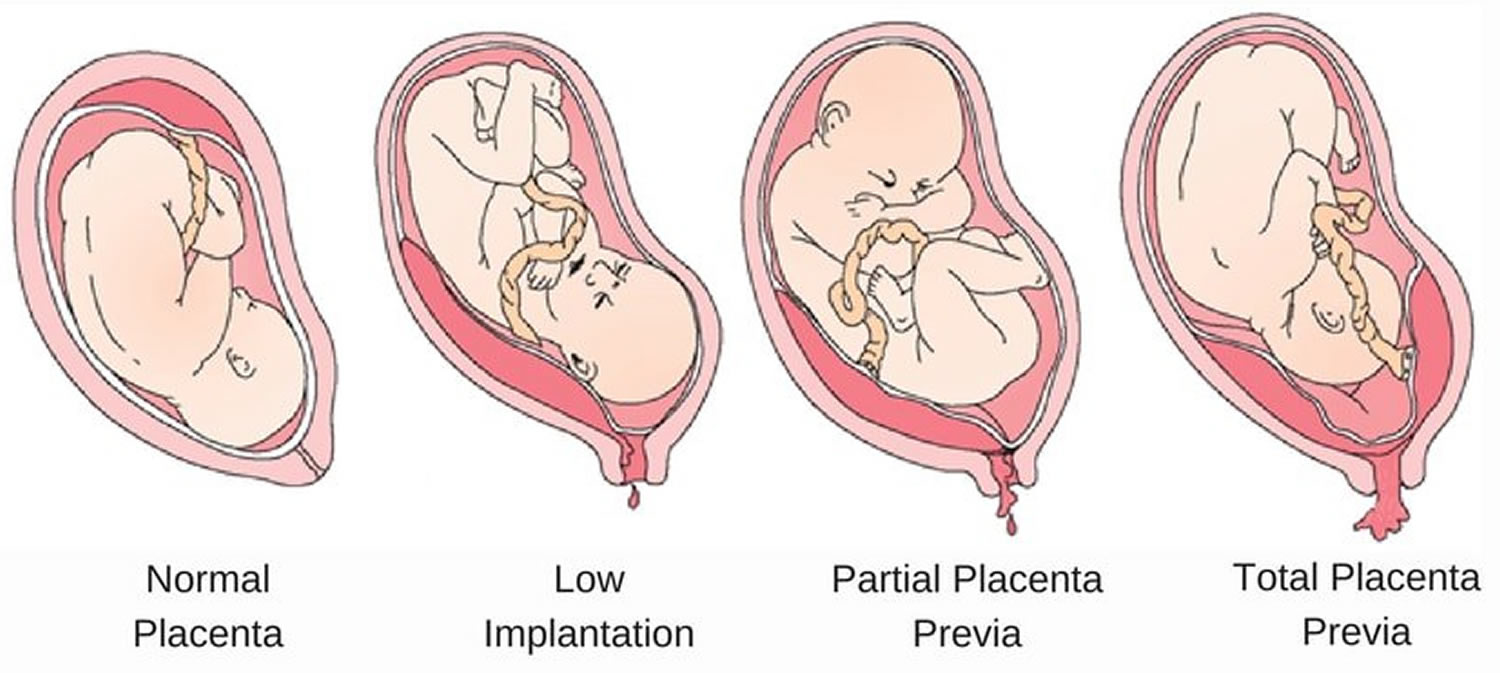 Placenta Previa Causes Signs Symptoms Treatment