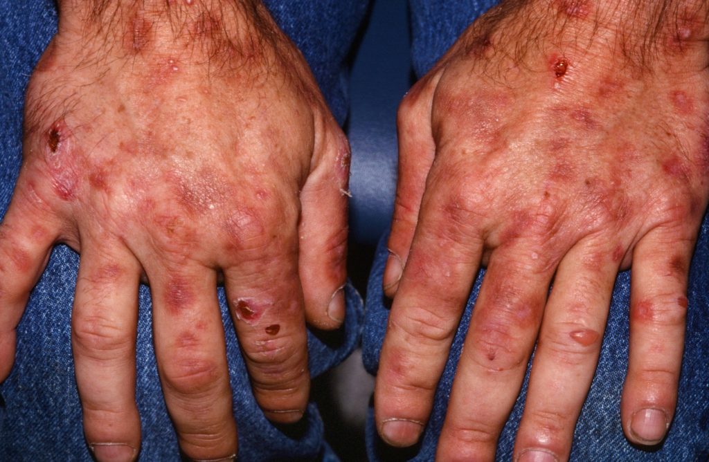 Porphyria Causes Symptoms Diagnosis Prevention Treatment