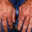 porphyria
