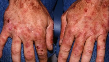porphyria