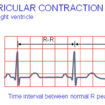 premature ventricular contractions