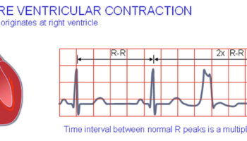 premature ventricular contractions