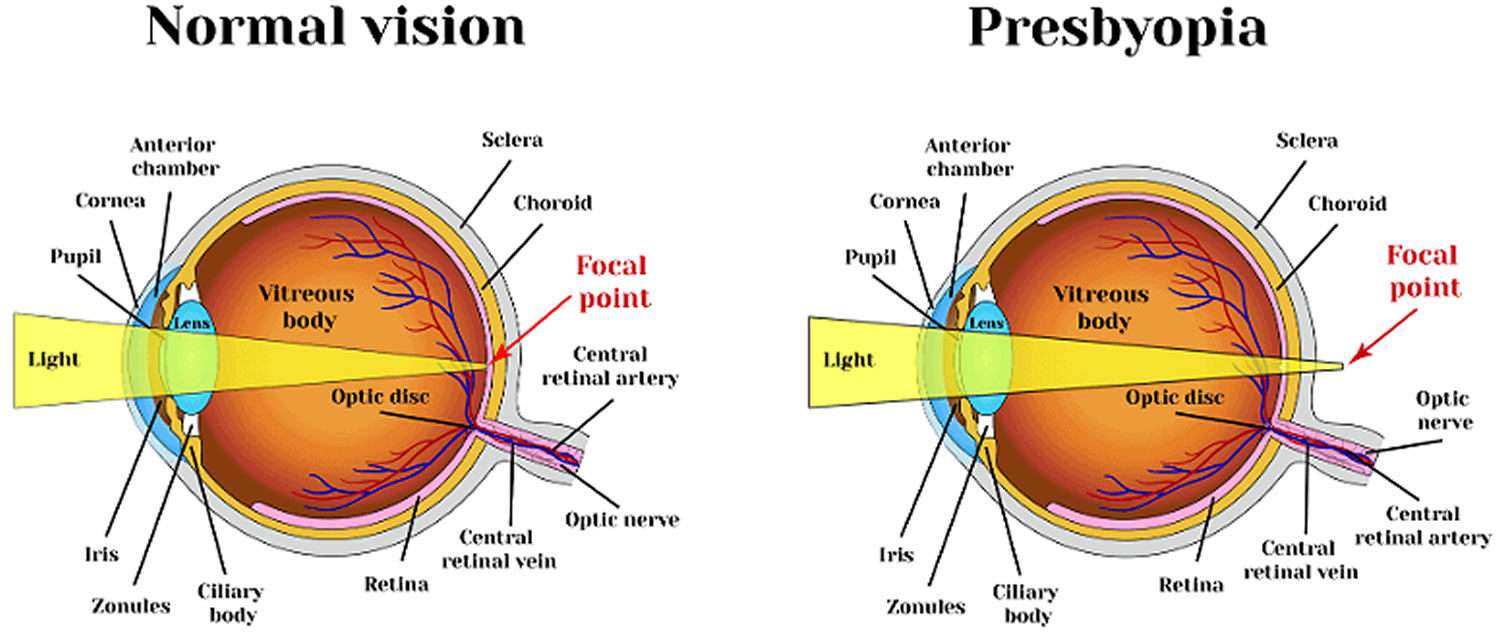 Presbyopia - Causes, Symptoms, Diagnosis, Surgery, Treatment