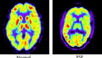 progressive supranuclear palsy