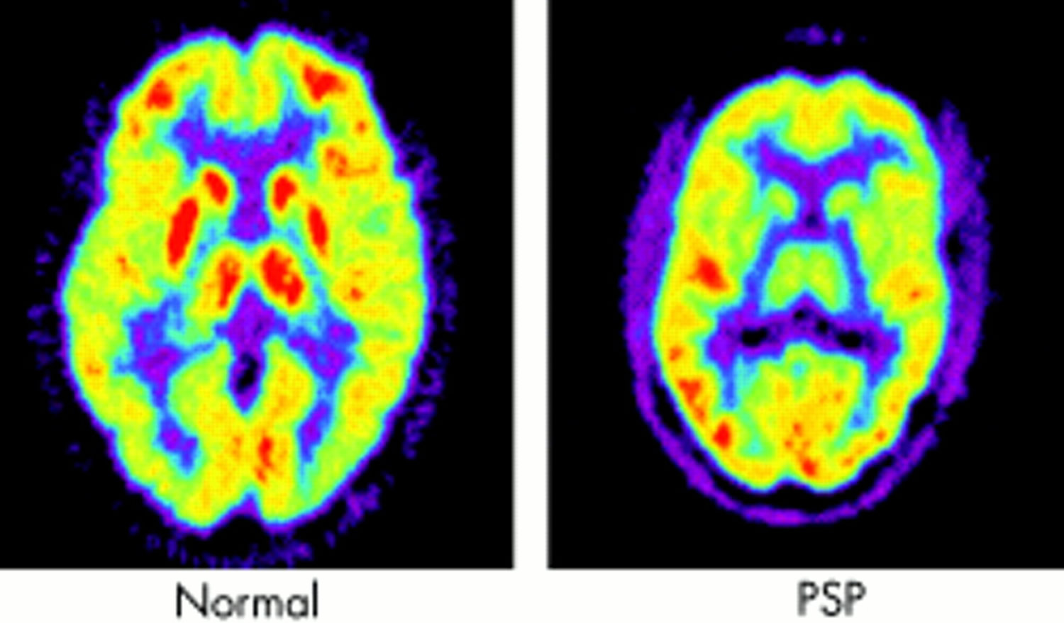 Progressive Supranuclear Palsy - Causes, Symptoms, Stages, Treatment