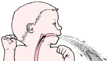 pyloric stenosis