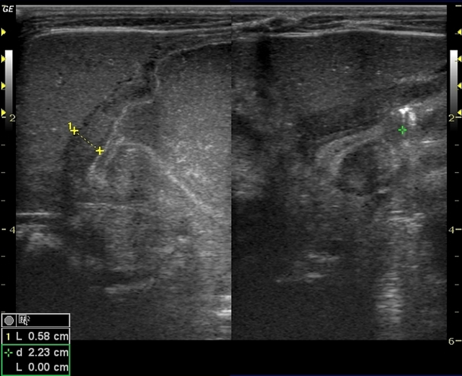 pyloric stenosis shoulder sign