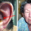 ramsay hunt syndrome