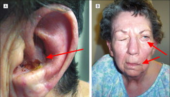 ramsay hunt syndrome