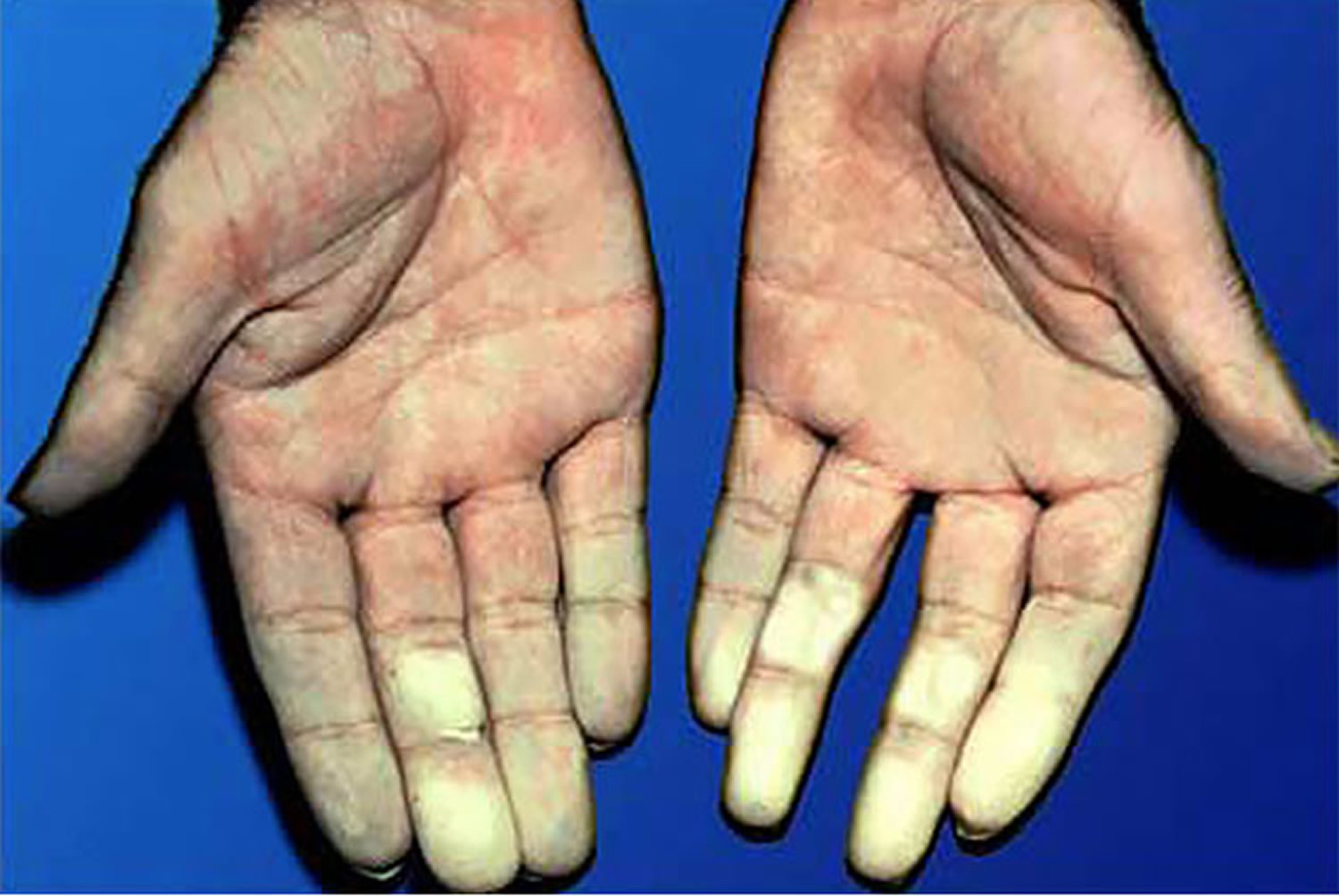 raynaud's disease fingers