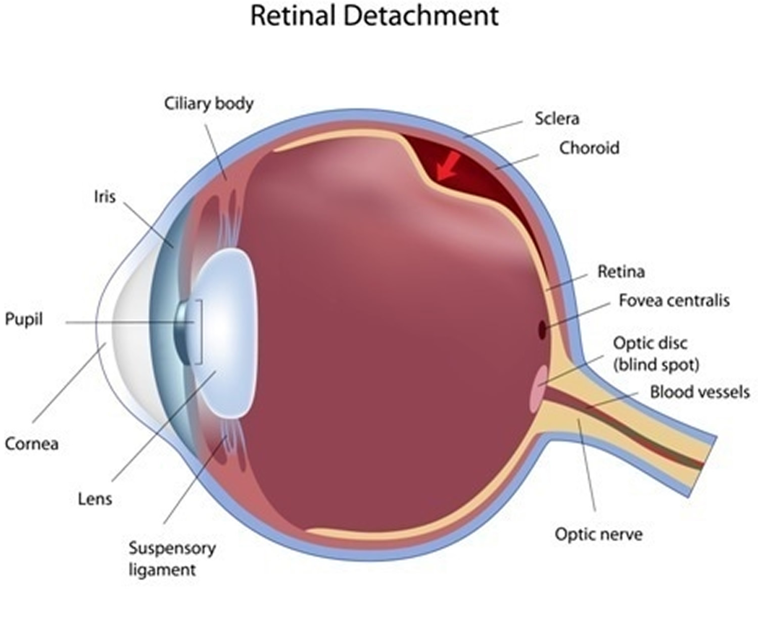 detached retina symptoms