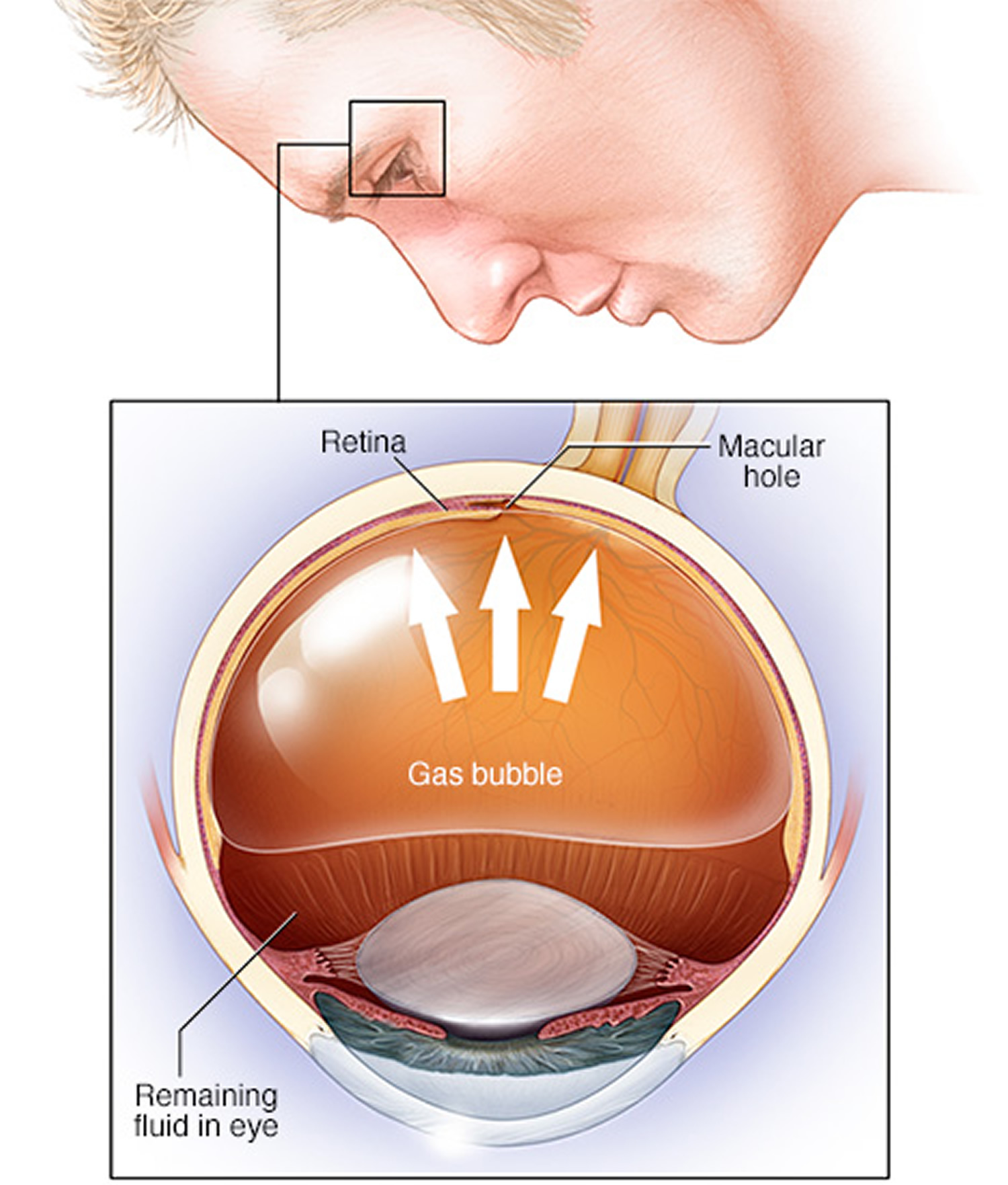 eye images after retina detachment surgery day 4