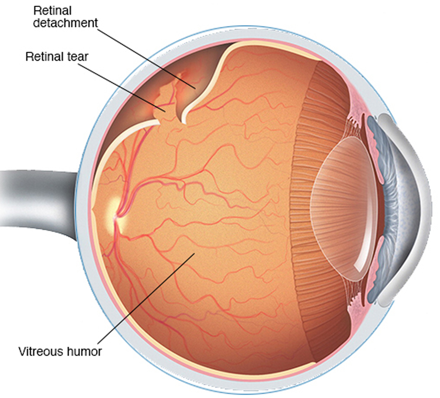 detached retina symptoms blood
