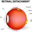 retinal detachment