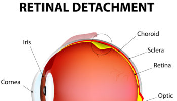 retinal detachment