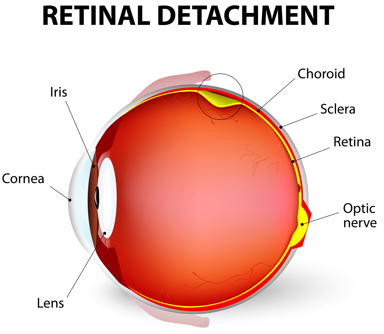 signs of a detached retina