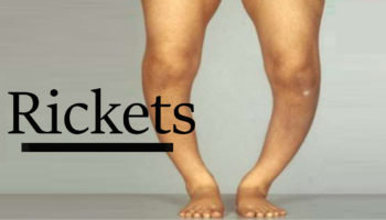 rickets