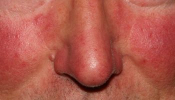 rosacea