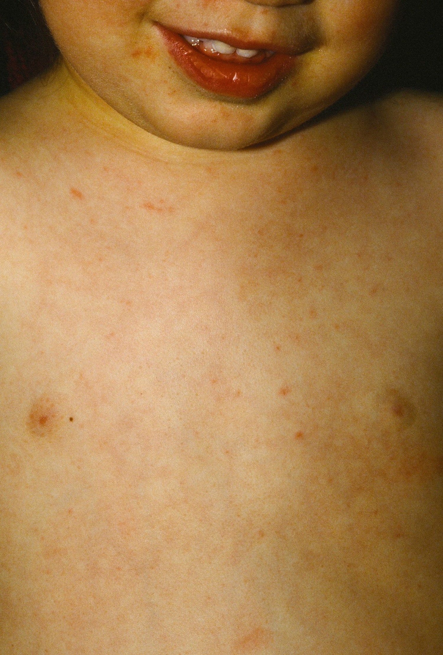 How Long Does Roseola Rash Last Babies