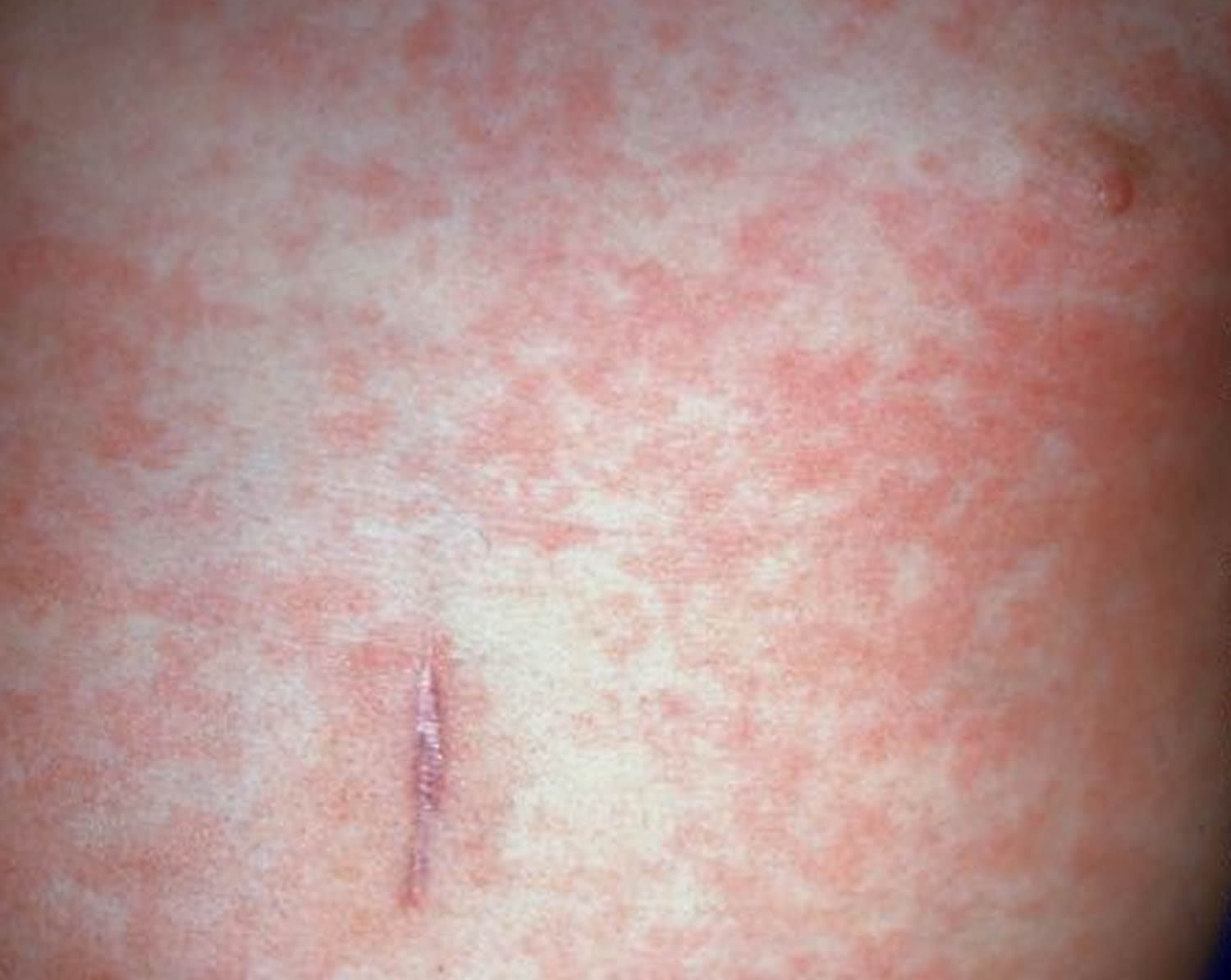 How Long Does Viral Infection Rash Last