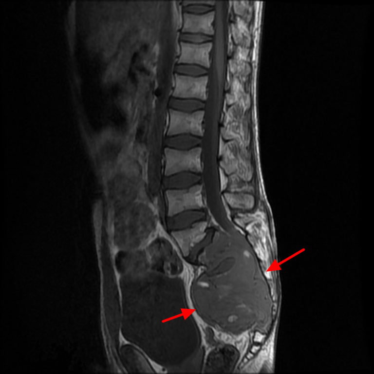 Chordoma Cancer - Causes, Symptoms, Life Expectancy, Treatment