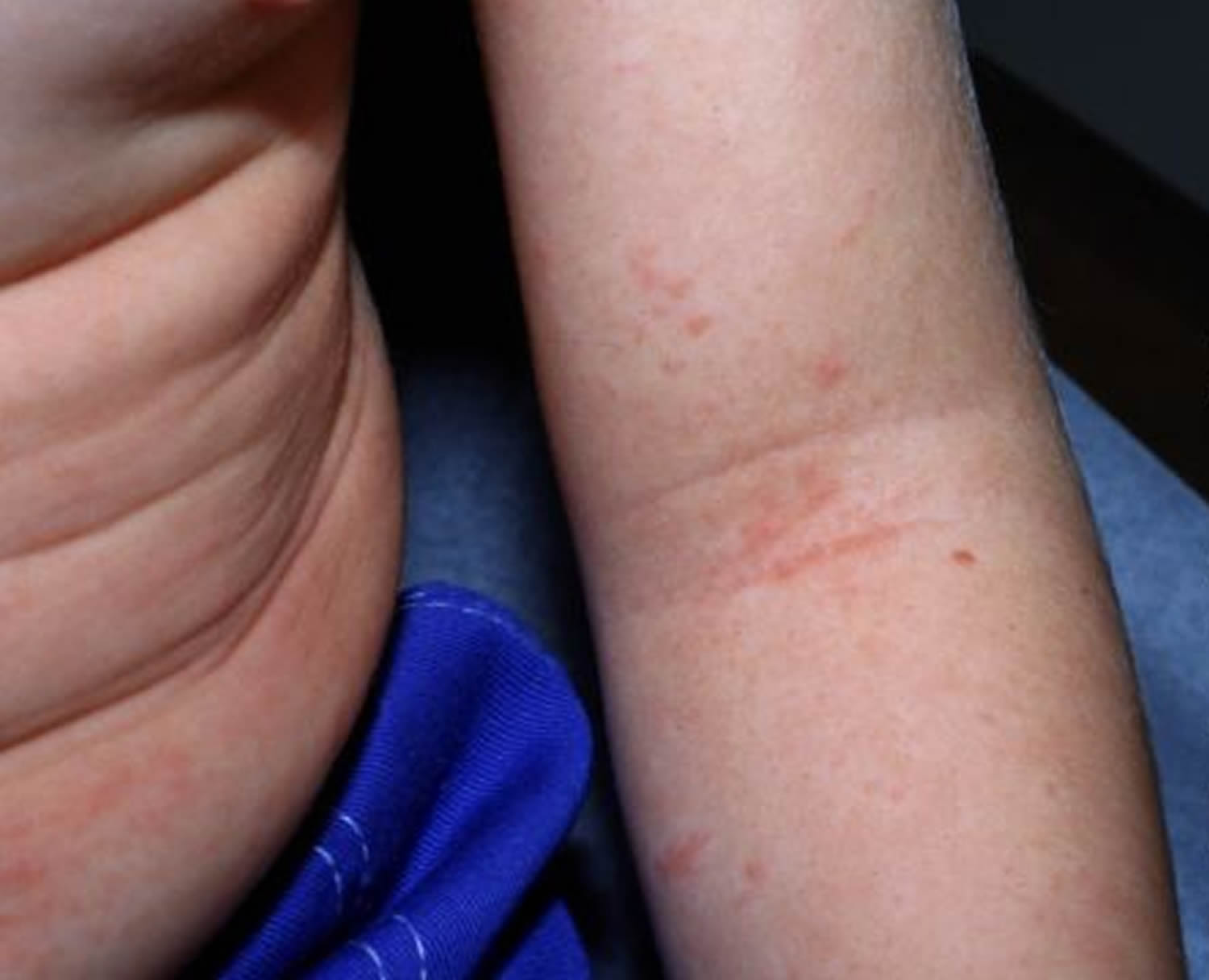 Scarlet Fever Makes A Dangerous Comeback