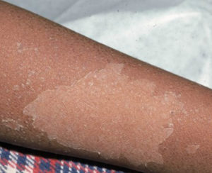 Scarlet Fever - Causes, Symptoms, Long Term Effects, Treatment