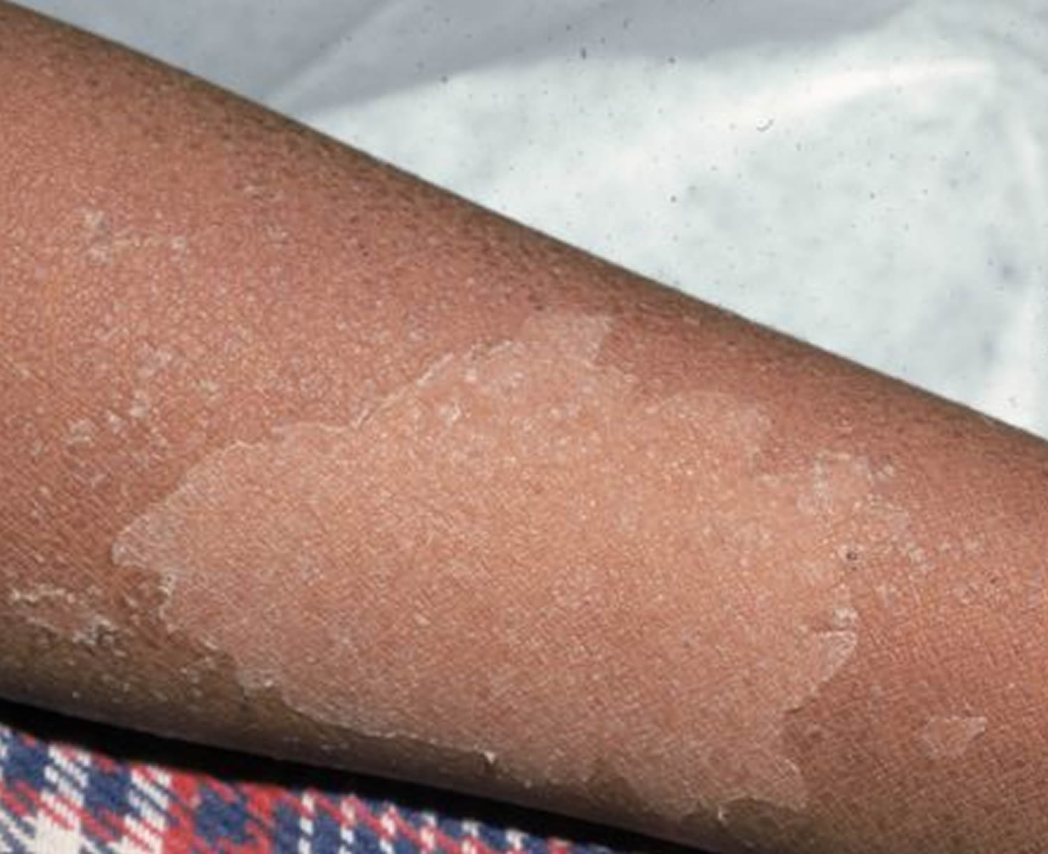 Scarlet Fever Causes, Symptoms, Long Term Effects, Treatment