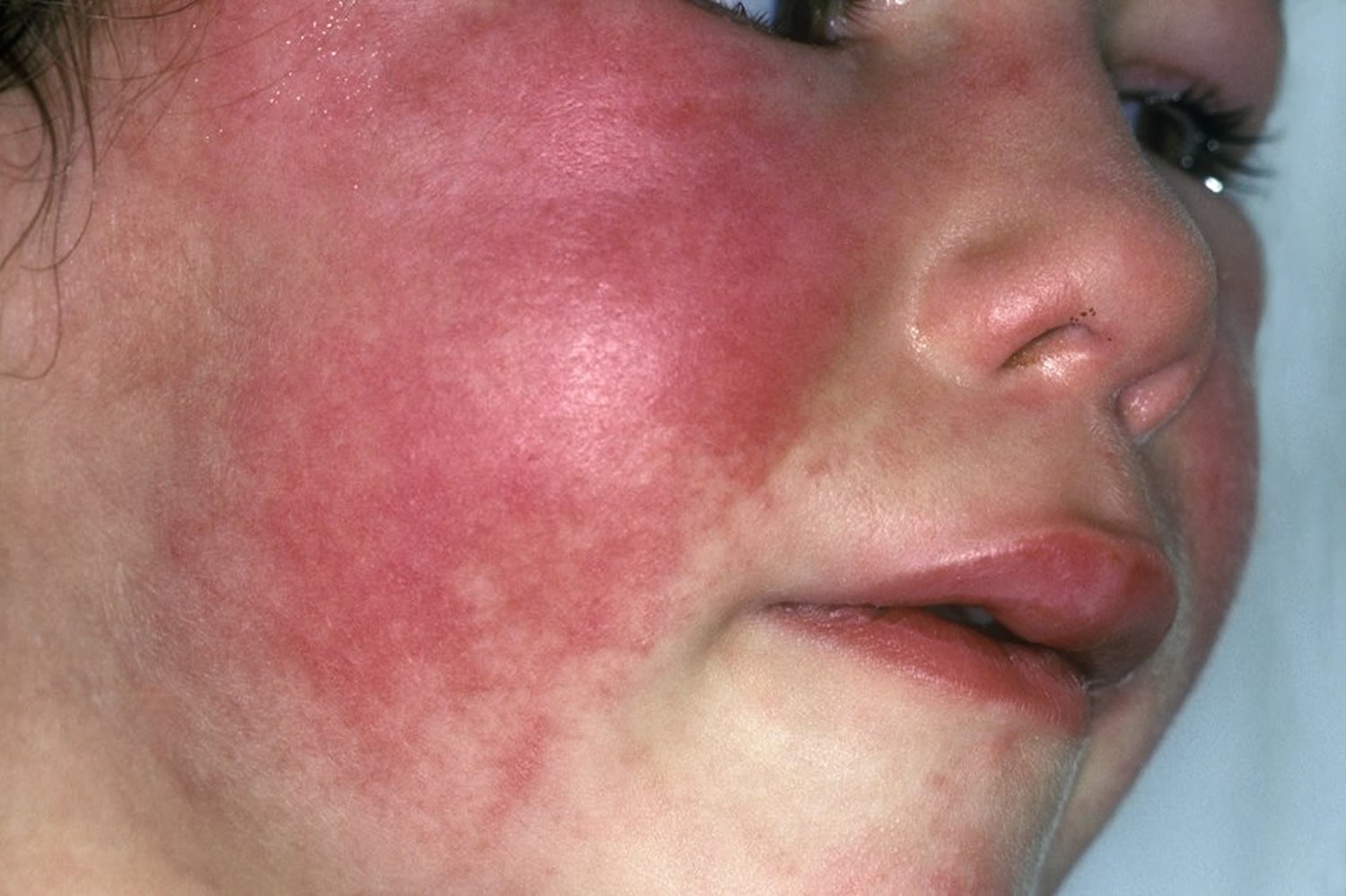 Scarlet Fever Causes, Symptoms, Long Term Effects, Treatment