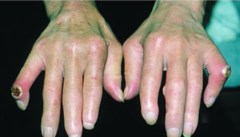 scleroderma