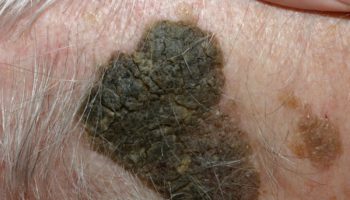 seborrheic keratosis scalp