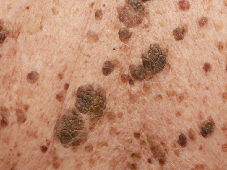 Seborrheic Keratosis Causes Symptoms Home Treatment