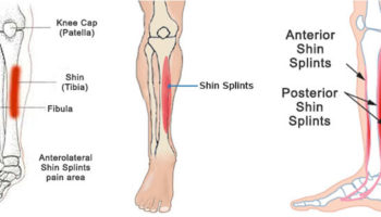 shin splints